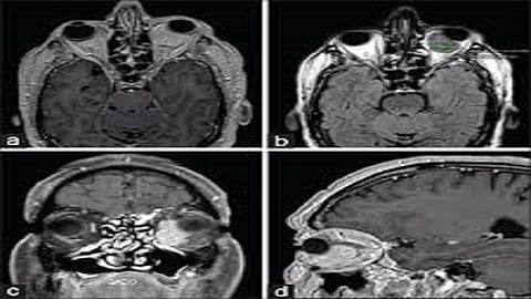 देव तारी त्याला कोण मारी! 'रोसाई डॉर्फमन' दुर्मिळ आजाराने ग्रस्त 20 वर्षीय श्रुतीवर यशस्वी उपचार