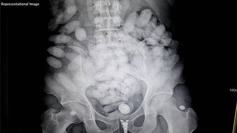 'त्या' बोलिव्हियन तरुणीच्या पोटात होतं सव्वा दोन कोटीचं घबाड...