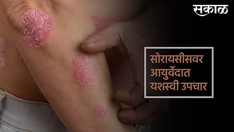 Ayurveda treatment is best for Psoriasis in India