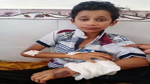 नांदगाव : कोब्राच्या दंशाने जखमी झालेला अर्थव राऊत.