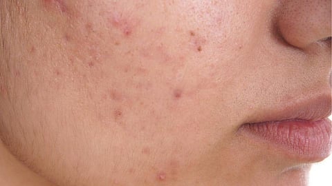 skin before bed to reduce facial acne in summer tips lifestyle marathi news