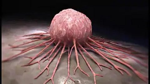 अबब! ४२ वर्षीय व्यक्तीच्या जबड्यातून काढला ९.५ सेंटिमीटरचा ट्यूमर; या रुग्णालयात झाली यशस्वी शस्त्रक्रीया