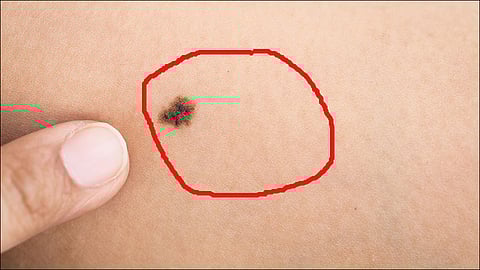 black spot on skin