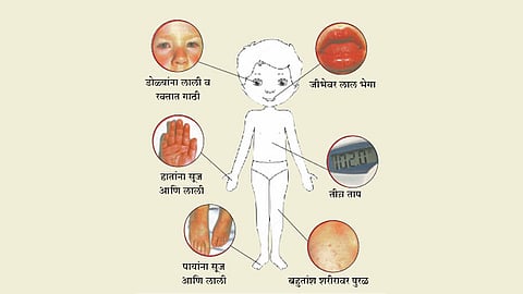 कोविडमुळे दक्षिण कोरियात मुलांना नवा आजार?