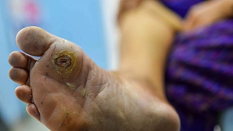 डायबिटीसग्रस्तांची चिंता मिटणार, 'डायबेटिक फूट अल्सर'वर वोक्सहिल ठरतंय गुणकारी