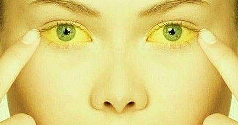 jaundice images.jpg