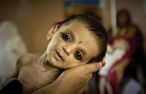 Now the search for malnourished children through growth monitoring