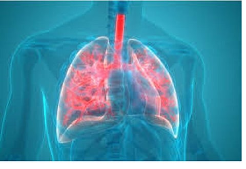 Did corona mean pneumonia? Find out