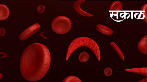 sickle cell patients