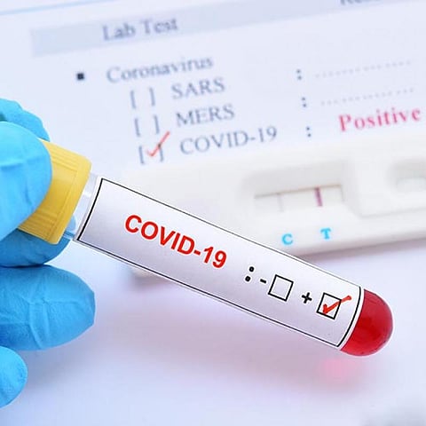 जळगाव जिल्ह्यात आणखी एक "कोरोना'बाधित; "त्या' मृताचा अहवाल "पॉझिटिव्ह'