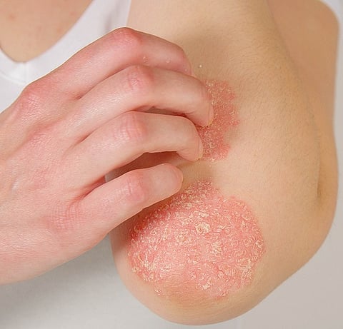 Psoriatic arthritis