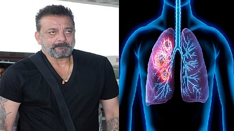 what is lungs cancer and what are the symptoms of it read full story