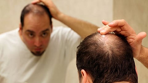 टक्कल पडलंय का? होय, त्यावर उपाय आहे!