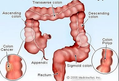 #HopeOfLife : आतड्याचा कर्करोग आणि कारणीभूत घटक