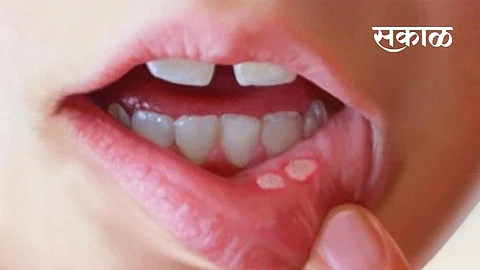 Suffering from mouth sores So get relief with this home remedy