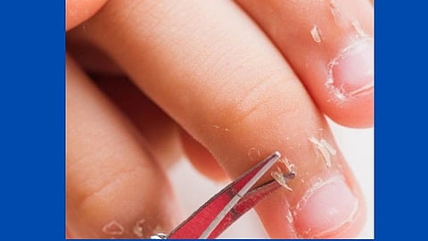 your finger skin is peeling use these homemade tips lifestyle marathi news