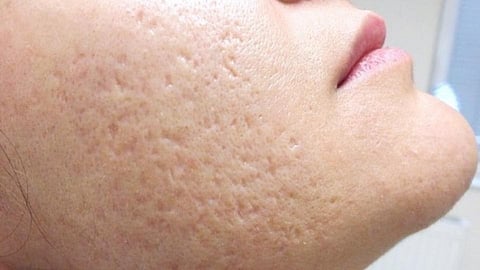 pores problem on face decreases beautiness of face of women in kolhapur