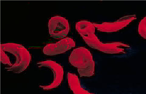 sickle cell center still not ready due to negligence of government in nagpur