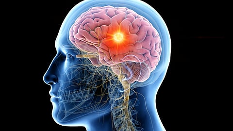 #WorldStrokeDay - चक्कर आल्यावर कांदा, चपलेचा वास देऊ नका; कारण आहे गंभीर