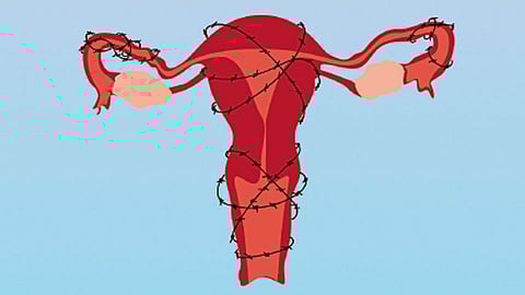 endometriosis