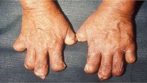 over 31 leprosy suspects search operation started