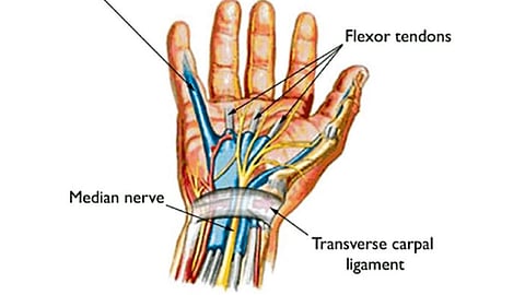 carpal tunnel syndrome