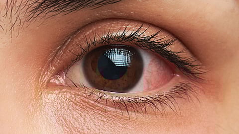 बुरशीजन्य आजार