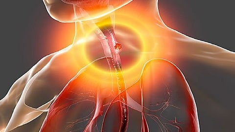 43 वर्षीय व्यक्तीच्या अन्ननलिकेतून काढला 8 सेंटिमीटरचा ट्यूमर