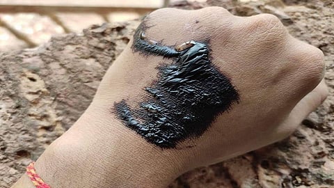 Sindhudurg district Home quarantine stamp blisters on the hands