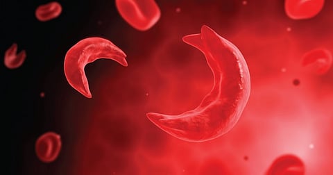 sickle cell.jpg