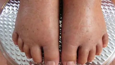 symptoms of water retention nagpur news