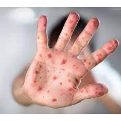 देशात ‘टोमॅटो फ्लू’ या नवीन आजाराची साथ; मुंबईत एकही रुग्ण नाही,केरळमध्ये आतापर्यंत ८२ मुलांना लागण