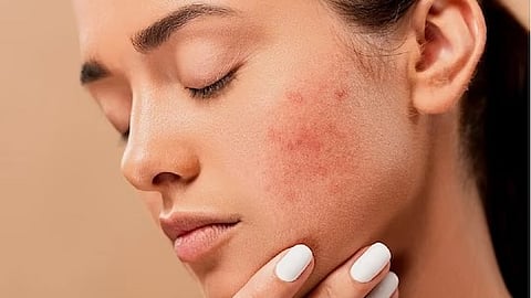 मुरुम आणि पुरळमुळे चेहरा खराब झाला का? केशर चेहेऱ्याला लावल्याने होतात फायदे