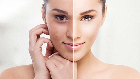 नैसर्गिकरित्या घालवा चेहऱ्यावरचे डाग, खड्डे; 'हे' करा घरगुती उपाय
