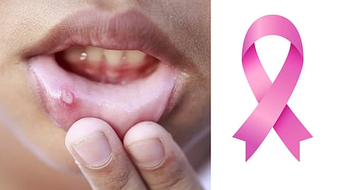 Health Care: तोंड येणे आणि मुखाचा कर्करोग या दोघांमध्ये काय आहे फरक? जाणून घ्या लक्षणं