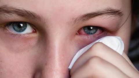 Eye Infections: पावसाळ्यात होऊ शकते डोळ्यांचे इन्फेक्शन; जाणून घ्या लक्षणं