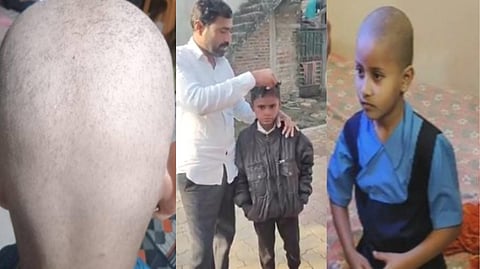 बुलढाण्यात ‘टक्कल व्हायरस’चा धुमाकूळ; तीन दिवसांत डोक्यावरील केस गायब