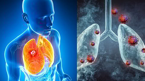 वायू प्रदूषणामुळे फुफ्फुसाचा कर्करोग वाढतोय; ‘लॅन्सेट’च्या संशोधनातील निष्कर्ष