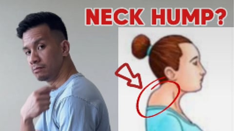 Neck Hump : नेक हंपच्या समस्येने त्रस्त आहात? हे व्यायाम प्रकार करून पाहा