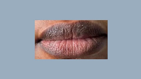 Tips To Lighten Dark Lips Naturally: ओठांच्या काळपटपणामुळे उदास आहात? ट्राय करा 'या' सोप्या टिप्स आणि पाहा फरक