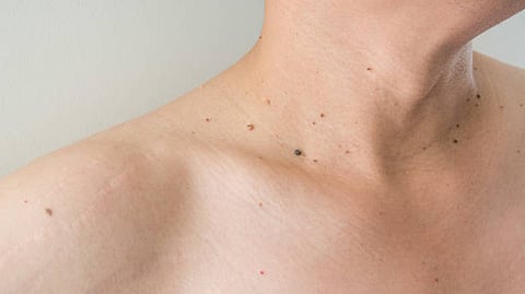 चामखीळ घालवण्यासाठी महागडे उपचार करताय? त्याआधी करा घरच्या घरी 'हे' ४ उपाय