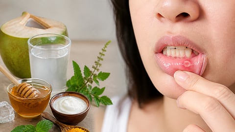 वारंवार तोंड येतंय? उष्णतेमुळे होणाऱ्या Mouth Ulcers वर करून पाहा हे घरगुती उपाय