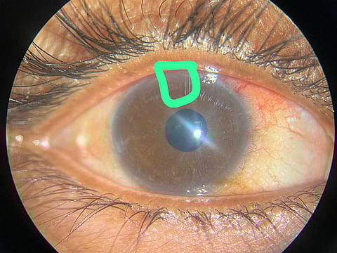 The affected eye of the 46-year-old woman who suffered from uncontrolled glaucoma.