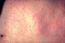 As of March 28, 2025, the CDC reported 483 confirmed measles cases across 20 states.