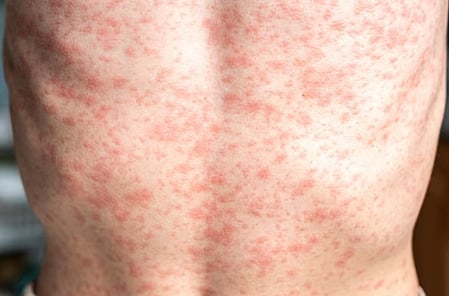 US reports fifth death due to measles. Outbreak in Pennsylvania has affected 943 patients in 29 counties, state officials said. Picture for illustrative purposes only.