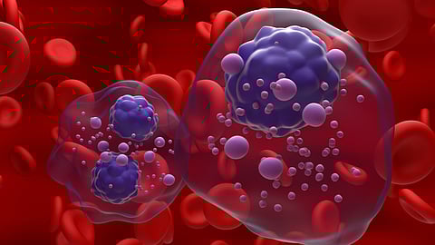 How early detection and innovative therapies improve outcomes for multiple myeloma