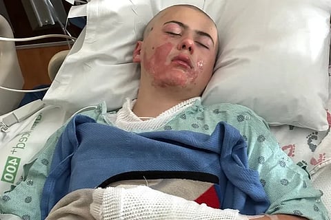 Caden Ballard lit himself on fire while filming it for a TikTok challenge called the "Fireball Challenge".