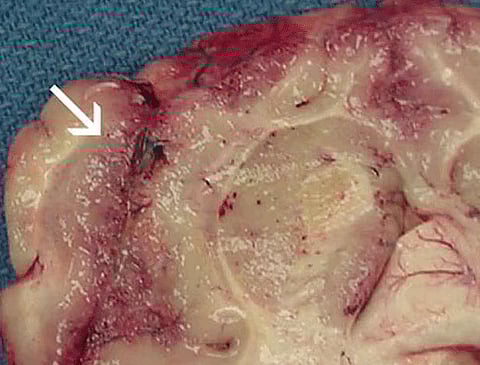 Focal hemorrhage and necrosis in frontal cortex due to Naegleria fowleri.