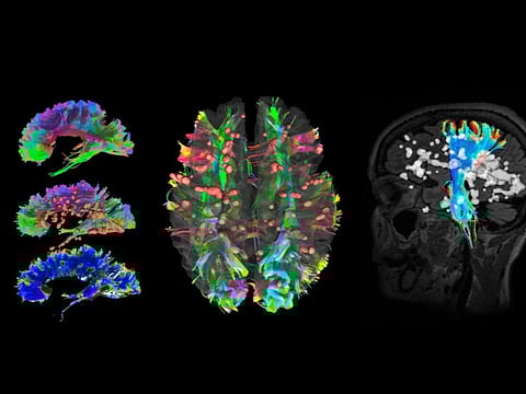 Abu Dhabi researchers create AI tool for faster multiple sclerosis diagnosis