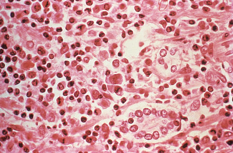 This 1994 handout photo from the US Centers for Disease Control and Prevention (CDC) obtained on May 6, 2026, shows a photograph taken through a microscope of a liver tissue specimen that was extracted from a hantavirus pulmonary syndrome (HPS) patient.